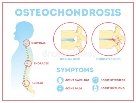Osteokondroz nedir, kendini nasıl gösterir ve nasıl tedavi edilir? / Propolis krem mumu Zdorov